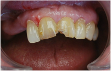 Original fractured tooth