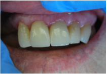 Final dental treatment