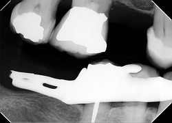 Final Delivery for crown. Existing partial upper denture is not shown in this x-ray. 